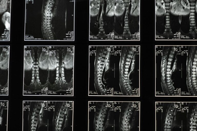 Average Settlement for Spinal Cord Injury - Featured image