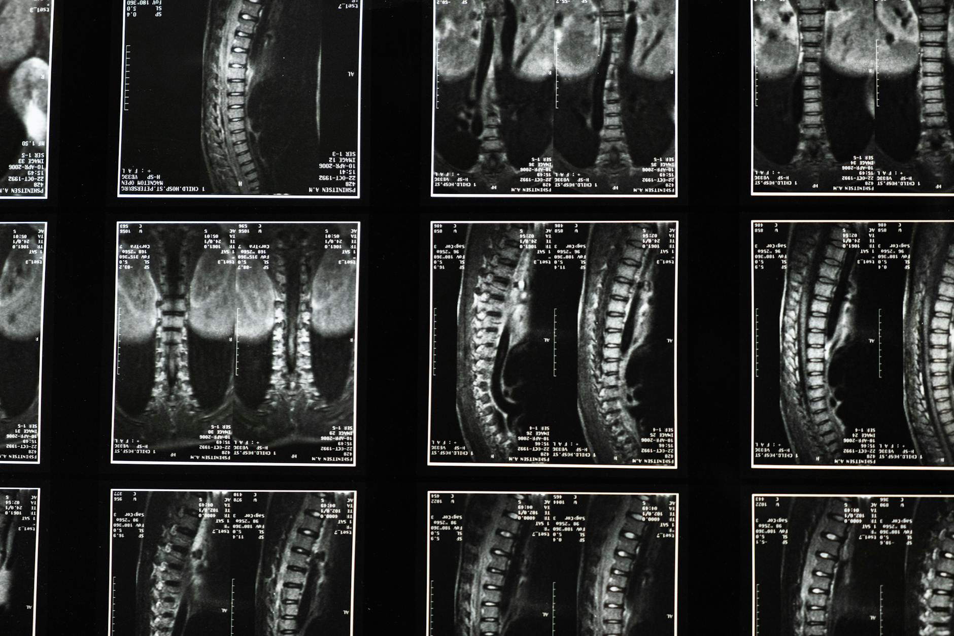 Average Settlement for Spinal Cord Injury - Featured image