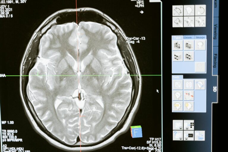 Average Settlement for Acquired Brain Injury - Featured image