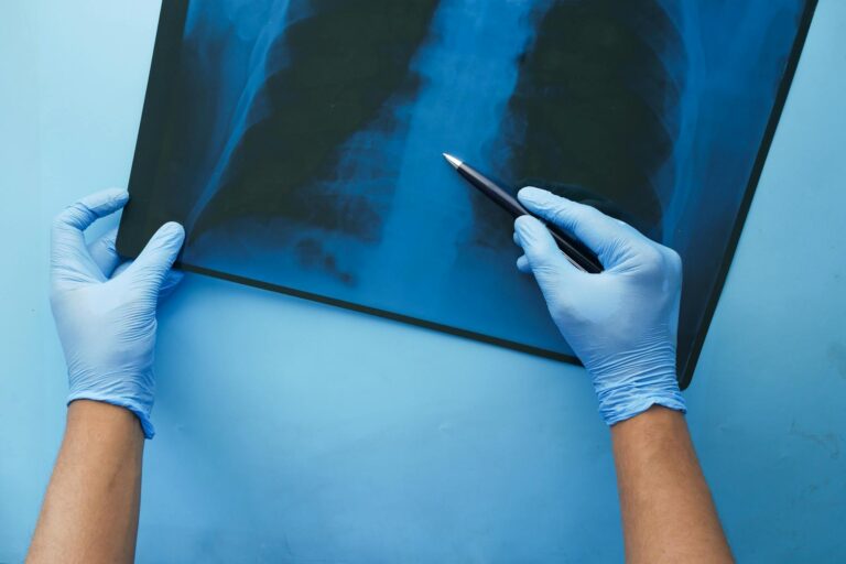 Average Settlement for Rib Fracture From Car Accident - Featured image