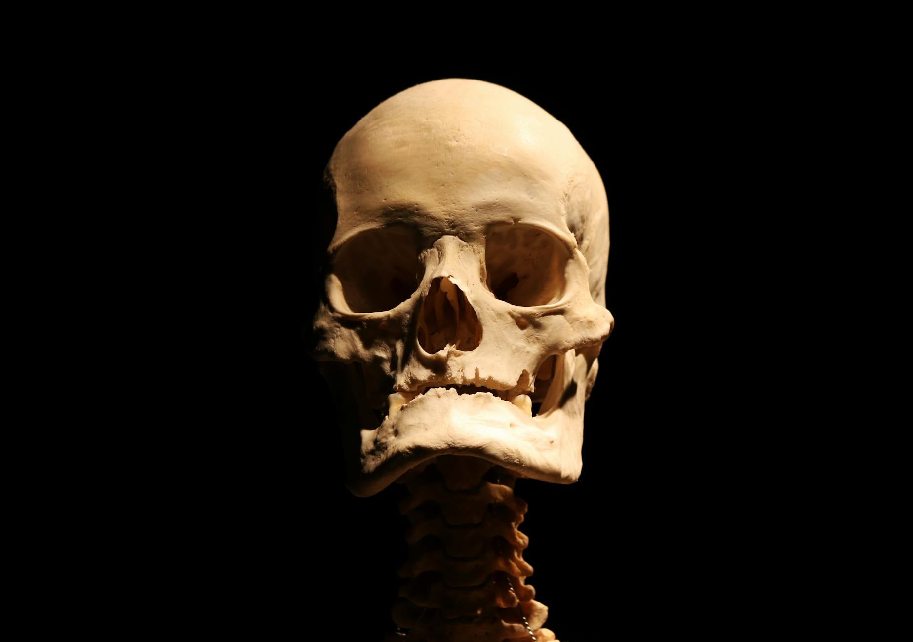 Settlement Amounts by Specific Bone Type